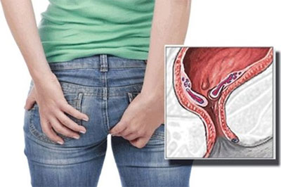 Obat Buang Air Besar Berdarah